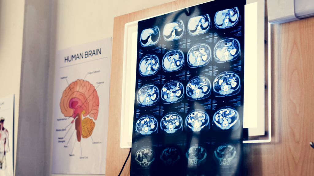 Exames de imagem da cabeça, para falar sobre a relação entre epilepsia e desenvolvimento congnitivo