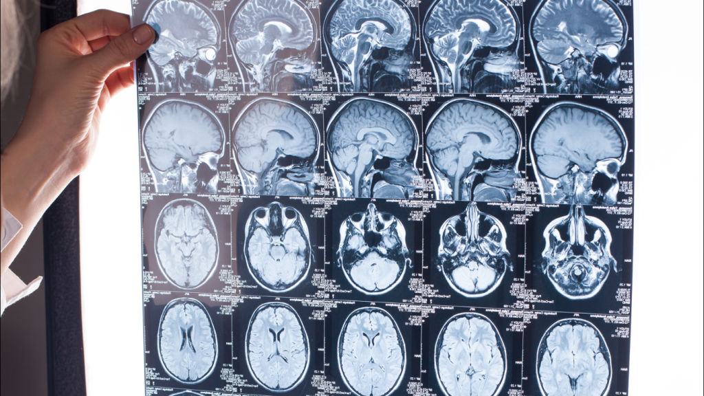 Médico analisando no exame de imagem as diferenças entre epilepsia focal e generalizada